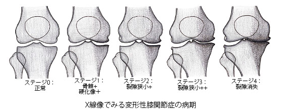 変形性膝関節症　東京顕微鏡歯科衛生士